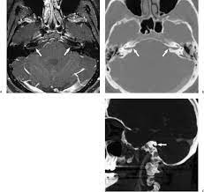 The Vestibulocochlear Nerve With An Emphasis On The Normal And Diseased Internal Auditory Canal And Cerebellopontine Angle Radiology Key