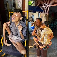 Love doesn't break in hardship — **it becomes stronger** 💛✨ At just **27  years old**, Arif lives with **congenital paralysis and hydrocephalus** 💔  When he was only **50 days old**, doctors performed