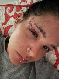 Suggestions for fast back recovery?