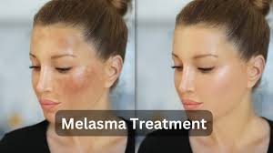 Image result for Melasma