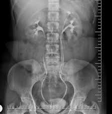 Incomplete Double Ureter Radiology Case Radiopaedia Org Radiology Radiology Humor Radiology Technologist