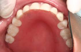 On average, expect the cost of a root canal without insurance to be around $1,000. The Average Cost Of Root Canal And Crown In Los Angeles