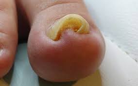 Früher hab ich es mal geschafft mir so warzen (auch die nach innen wachsenden am. Rollnagel Und Ihre Behandlungsmoglichkeiten Fusspflegeblog