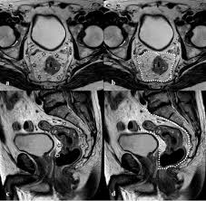 Beating bowel cancer charity and online clinic health express have teamed up to raise awareness of the signs and symptoms of bowel cancer, which can often be mistaken for piles +6 about half of. Mri For Rectal Cancer Primary Staging And Restaging After Neoadjuvant Chemoradiation Therapy How To Do It During Daily Clinical Practice European Journal Of Radiology