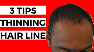 Curly hair is very hard to take care of. 3 Tips For Thinning Hair Line Black Men Balding Youtube