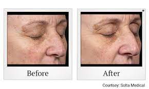 | a+ medical care | aaron feinstein, md, inc. Cosmetic Treatments San Ramon Body Sculpting Facial Treatments Provided