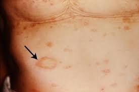 Maybe you would like to learn more about one of these? Pityriasis Rosea Doccheck Flexikon