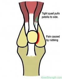 Pin On Patella Maltracking My Sore Knees