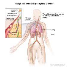 Thyroid cancer (carcinoma) usually appears as a painless lump in this area. Thyroid Cancer Treatment Adult Pdq Patient Version National Cancer Institute