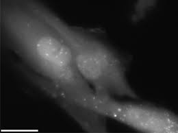 Find the perfect chernobyl disaster stock photos and editorial news pictures from getty images. Acute Radiation Syndrome Wikipedia