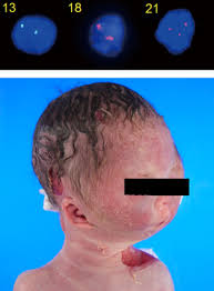 Image result for Micrognathia