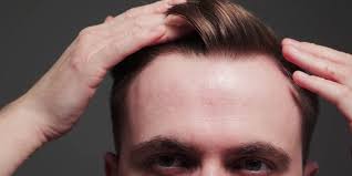 But if hair follicles become damaged for any number of reasons, the result can be hair loss and a receding hairline. This Guy Just Shared 5 Tips For Hiding A Receding Hairline