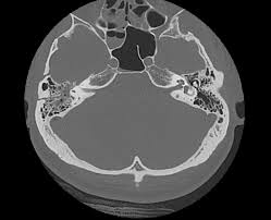 Image result for Ossicular Chain Disruption
