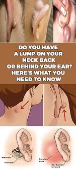Check spelling or type a new query. Do You Have A Lump On Your Neck Back Or Behind Your Ear Here S What You Need To Know Epidermoid Cyst Lump Behind Ear Skin Bumps