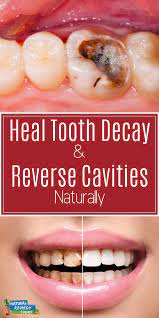 Reverse Tooth Decay Tooth Decay Tooth Decay Remedies Tooth Tooth Ache Relief Tooth Teeth Reverseto Tooth Decay Remedies Reverse Cavities Tooth Decay