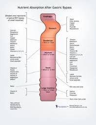 Pin On Bariatric Surgery Weight Loss Surgery