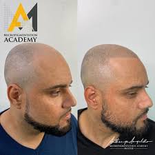 Stock up before we sell out. Scalp Micropigmentation Training Smp Certification And Courses