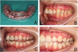 Foods that are bitten into such as meat on the bone or corn on the cob should be cut in to bite size pieces. Full Coverage Ars In The Therapeutic Protrusive Jaw Position A The Download Scientific Diagram