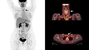 Doctors often order pet scans to stage a cancer or to assess whether treatment is working. Pet Ct Detection Of Fludeoxyglucose F 18 Injection 18f Fdg 1 Avid Radioiodine Negative Recurrent Thyroid Cancer