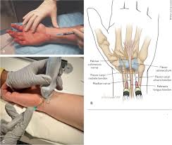 Image result for TFCC Steroid Injection