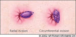 Thrombosed hemorrhoids are ruled out to be dangerous. Hemorrhoidectomy For Thrombosed External Hemorrhoids American Family Physician