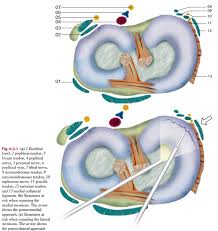 Meniscus surgery can fix an injured or torn meniscus, a piece of cartilage in the knee joint. Meniscal Repair Physiopedia