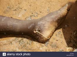 Durch präventionsmaßnahmen konnte die verbreitung des wurmes. Guinea Worm Emerging Niger Stockfotos Und Bilder Kaufen Alamy