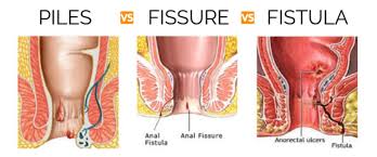 Irritable bowel syndrome (ibs) is a functional disorder of the digestive tract. Piles Specialist In Borivali Fissure Fistula Dhanvantari Hospital