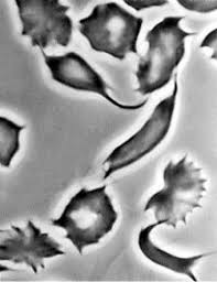 Sickle cell anemia) ist eine erbliche erkrankung der roten blutkörperchen (erythrozyten). Sichelzellen Lexikon Der Biologie