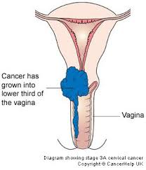 Gejala awal kanker serviks pada stadium lanjut, di antaranya yakni: Staging Cervical Cancer