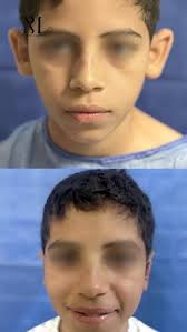 الألم مسيره يروح والنتيجة الحلوة هي اللي بتفضل✨ وانت كمان قولنا بتفكر في  خطوة إيه في رحلة تجميلك؟ وابعتلنا كل اسئلتك 💖 #جسم_متناسق #التثدي  #شفط_الدهون #دهون_موضعية #plastic_surgery# lipfiller