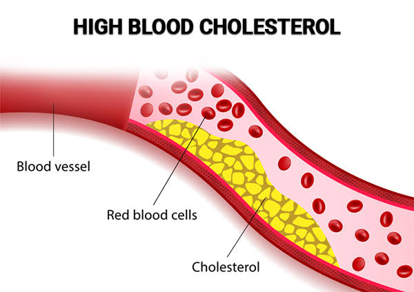 High Cholesterol Treatment NYC | High Triglycerides Specialists ...