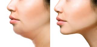 Liposuction of Face