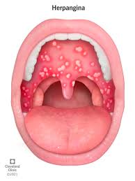 Image result for Canker sores symptoms roof of the mouth