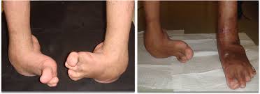Image result for Clubfoot