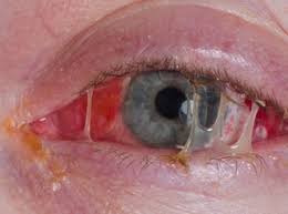 Image result for Conjunctivitis Resources