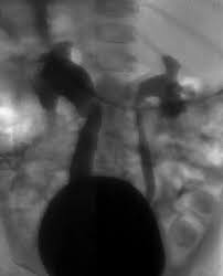 Image result for Voiding Cystourethrogram