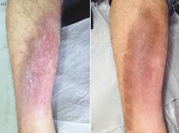 Image result for Lichen Simplex Chronicus