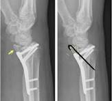 Volar Plate Fixation - an overview | ScienceDirect Topics