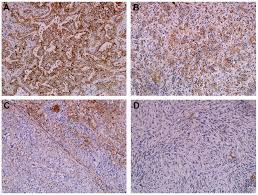 Epithelioid mesothelioma pathology outlines present that epithelial cells are characterised by their tumors often have epithelioid options and sometimes areas of benign schwannoma am j surg archives of pathology laboratory medication. Cd9 Expression As A Favorable Prognostic Marker For Patients With Malignant Mesothelioma