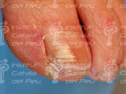 We did not find results for: La Leuconiquia O Unas Con Manchas Blancas Institut Catala Del Peu