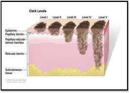 During a sentinel node biopsy, a dye is injected in the area where your melanoma was removed. Stages Of Melanoma Skin Cancer Adapted With Permission From National Download Scientific Diagram