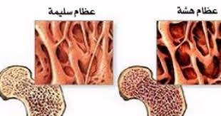نصائح للوقاية من هشاشة العظام أهمها ممارسة الرياضة اليوم السابع