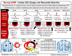 St Elevations Monitoring For Infarction Stemi