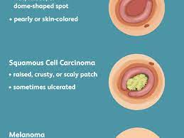 Basically, a seroma is a collection of clear fluid (usually blood serum or blood plasma) under the skin. Skin Cancer Signs Symptoms And Complications