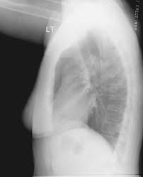 Digital Radiography Image Artifacts Radiology Suny Upstate Medical University