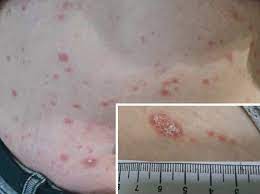 Papulosquamous eruption of pityriasis rosea. Pityriasis Rosea Roschenflechte Als Mogliche Nebenwirkung Einer Impfung Gegen Covid 19