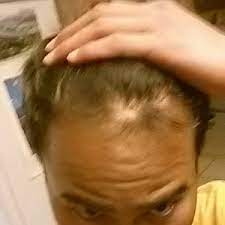 Generally this medication has a modest affect on hair growth. Is It Possible To Regrow My Hair In The Scar On The Top Front Of My Head Photo