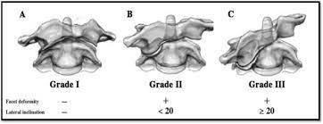 Acute Atlantoaxial Rotary Subluxation Aars Pediatric Orthopaedic Society Of North America Posna