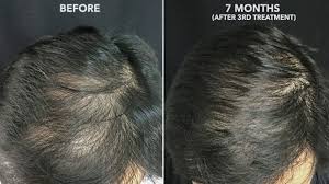 It's not all about enhancing the looks! Prp Hair Treatment Success Rate Does It Work For Hair Loss